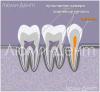 كيفية البحث عن قنوات الأسنان وعلاجها في لوميدنت