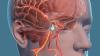 الدماغ تمدد الأوعية الدموية: اختبار نفسك