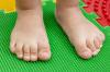 الأشكال "الجيدة" و "الشريرة" للأقدام المسطحة عند الأطفال