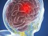 ورم في المخ: 5 الأعراض التي لا يمكن تجاهلها