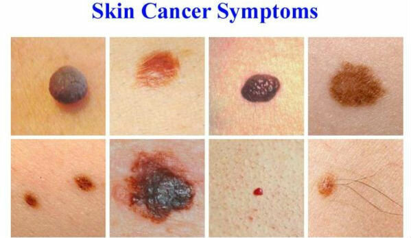أعراض سرطان الجلد